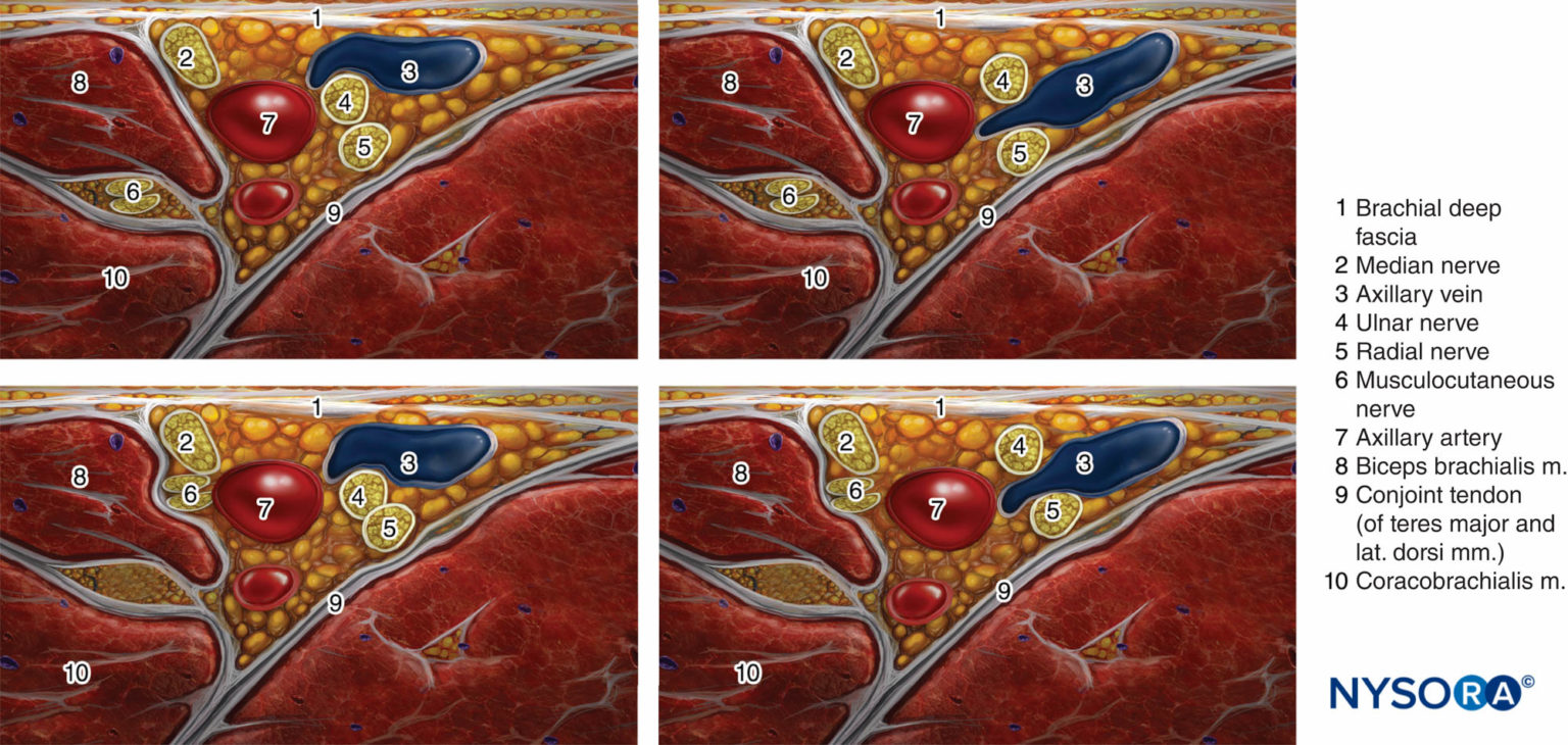 |Die häufigsten Muster der Nervenlokalisation um die A. axillaris bei ultraschallgeführter Blockade des axillären Plexus brachialis.